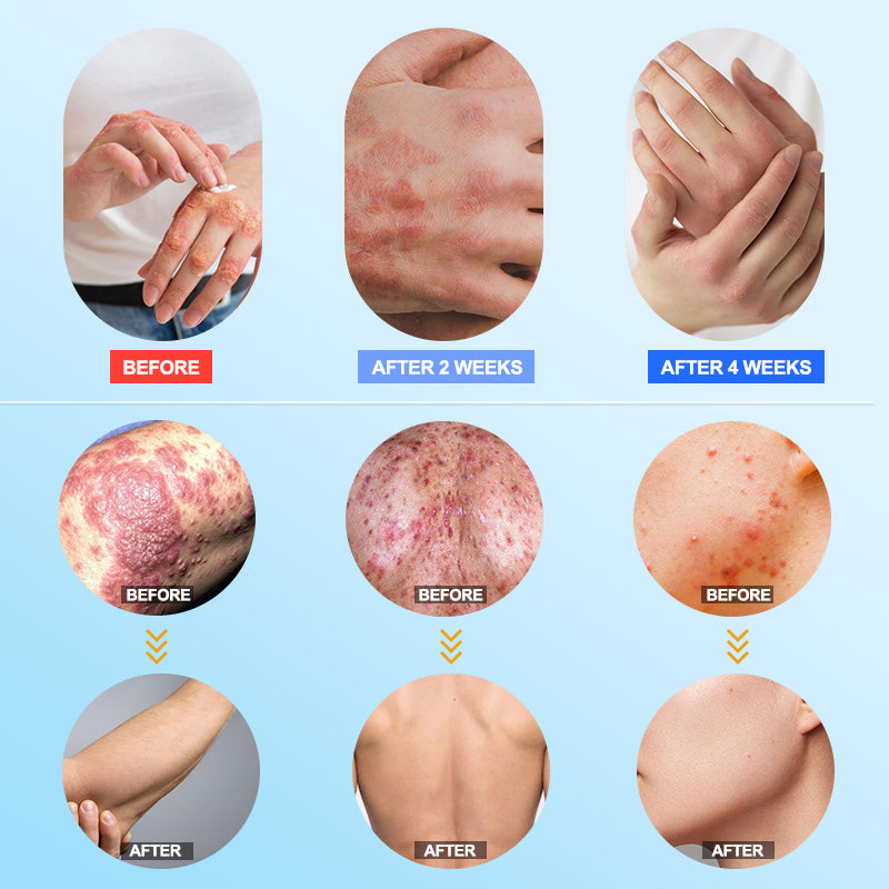👉 Official Store: PCA-Magnesium Herbal Intimate – Multi‑Purpose Relief for Scalp Itching, Eczema, Jock Itch, Facial Acne & Fungal Infections | Herbal Extracts, Steroid‑Free, No Artificial Fragrances, Gentle for All Skin Types【Tax Free】