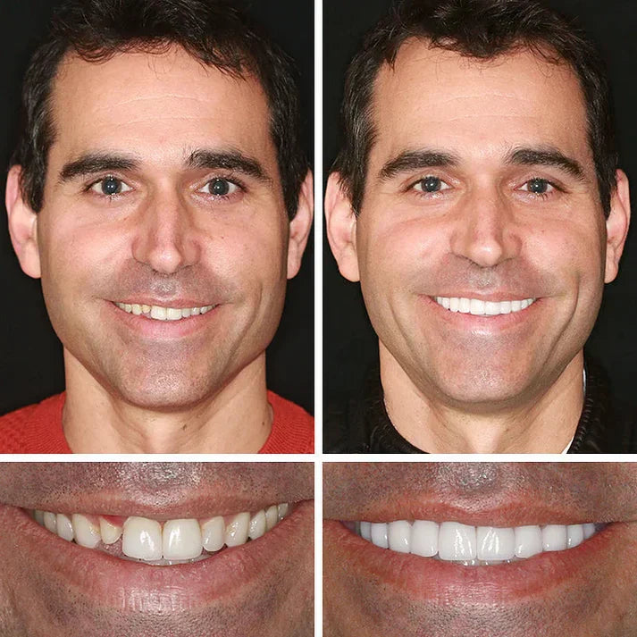 Ends Today: 70% OFF! ⏰70% OFF! KLENIMORE™ Medical Full Denture with Strong Suctiond Custom-Fit Full Functional Dentures🦷Obtain American Dental Association (ADA) Certification