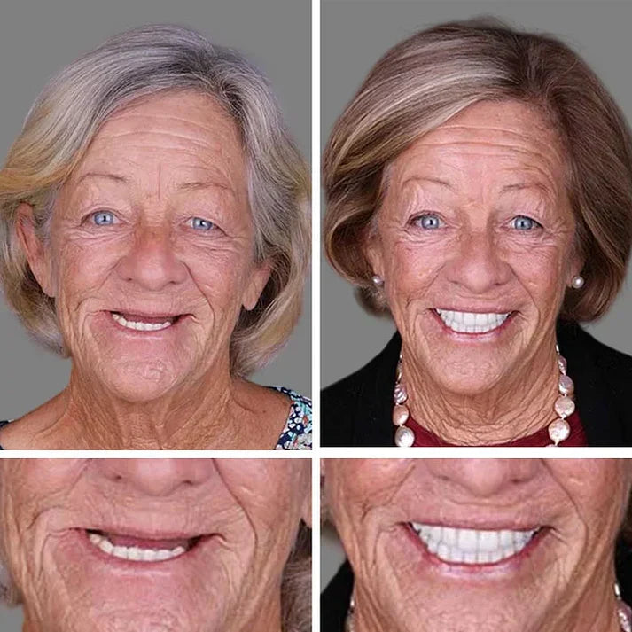 Ends Today: 70% OFF! ⏰70% OFF! KLENIMORE™ Medical Full Denture with Strong Suctiond Custom-Fit Full Functional Dentures🦷Obtain American Dental Association (ADA) Certification